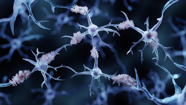 3D rendering of neurons with amyloid-beta plaques, characteristic of Alzheimer’s disease.
