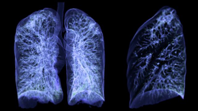 X-ray image of patient with lung cancer.