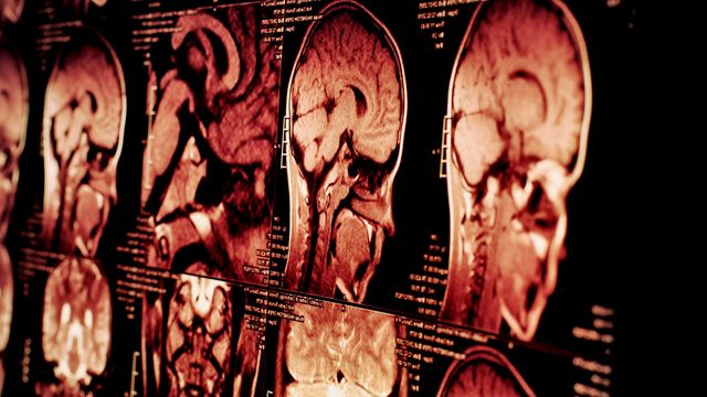 Close-up of MRI brain scans highlighting abnormal regions, potentially indicating a brain tumor