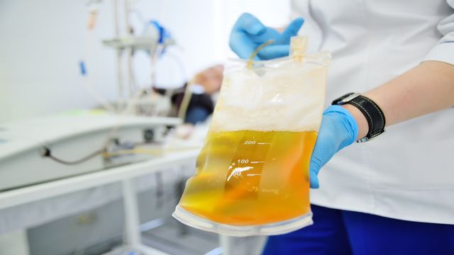 Medical professional holding a plasma bag in a clinical setting for plasma proteomics analysis. 
