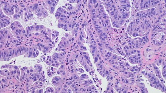 Immunohistochemistry slide of cancer tissue viewed under a microscope. 