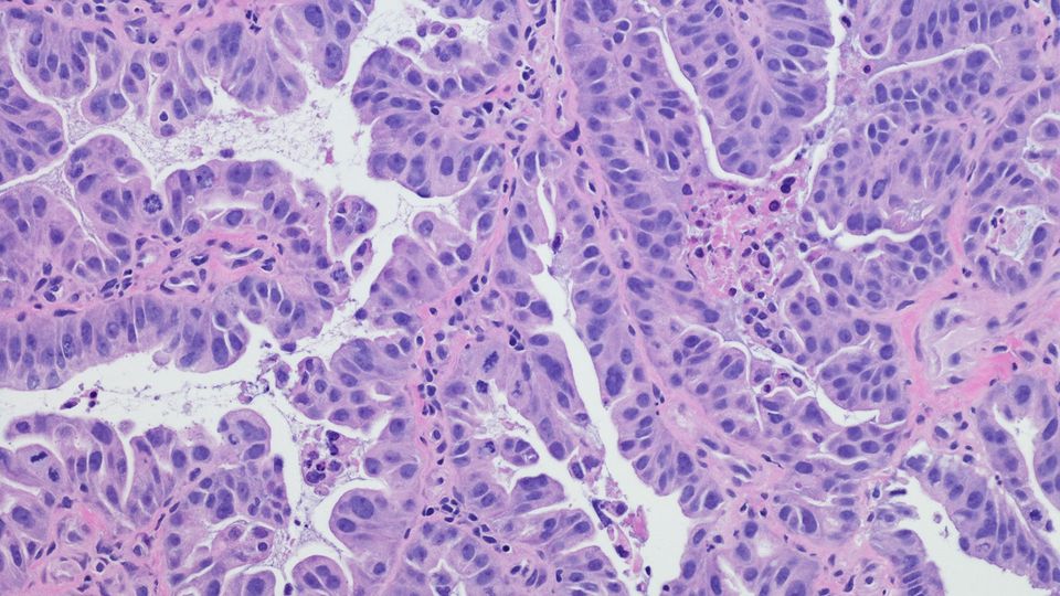 Immunohistochemistry slide of cancer tissue viewed under a microscope.