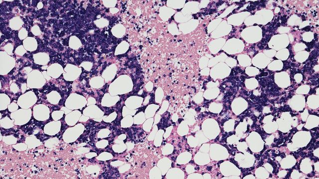 Microscopic view of bone marrow cells, relevant to liquid biopsy analysis in cancer diagnostics.