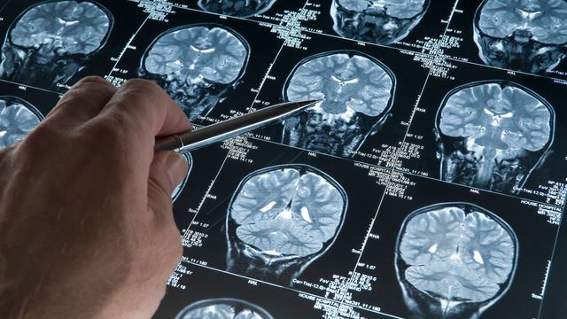 Doctor pointing at brain MRI scans showing areas related to nerve cell activity.